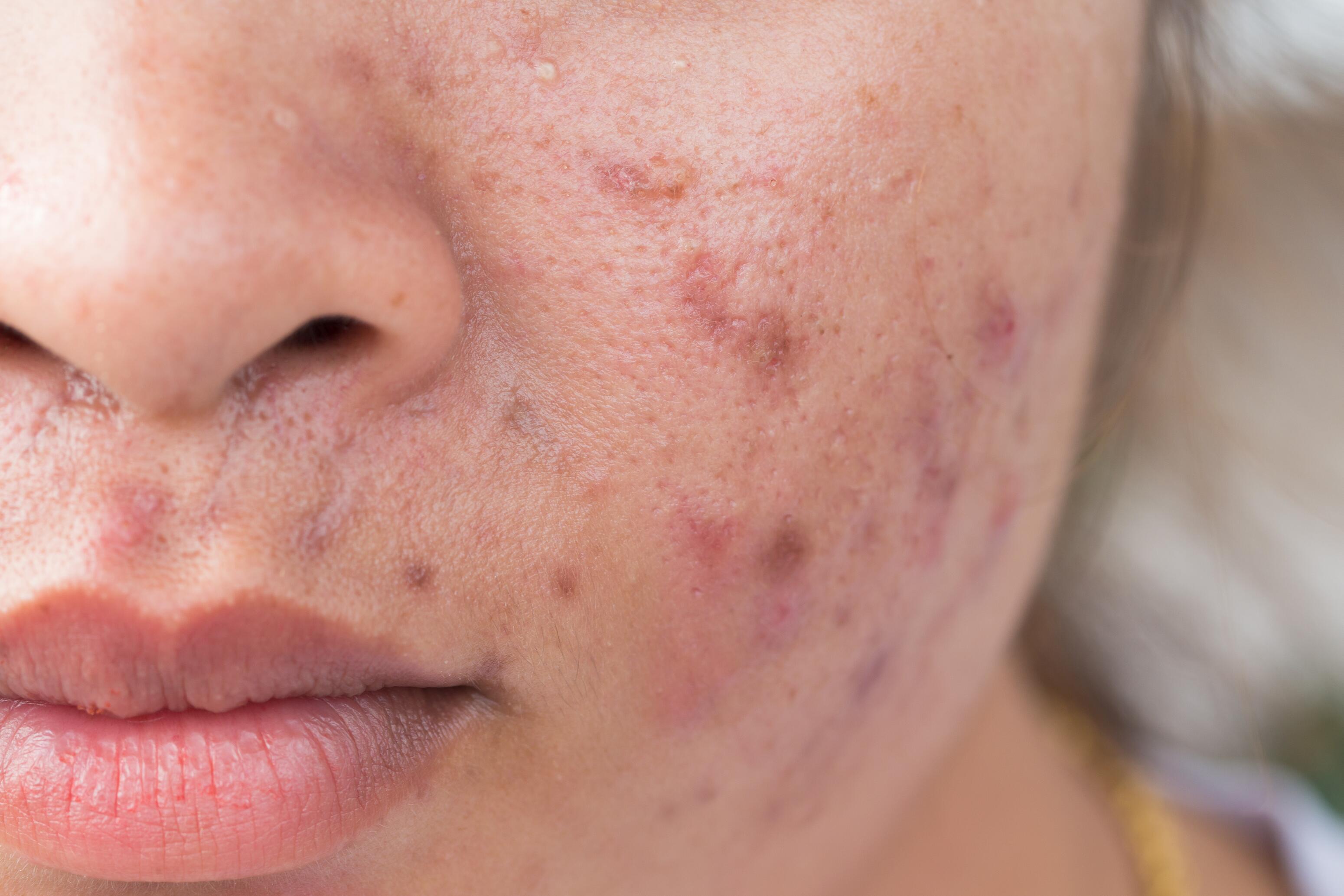 Hypertrophic acne scars